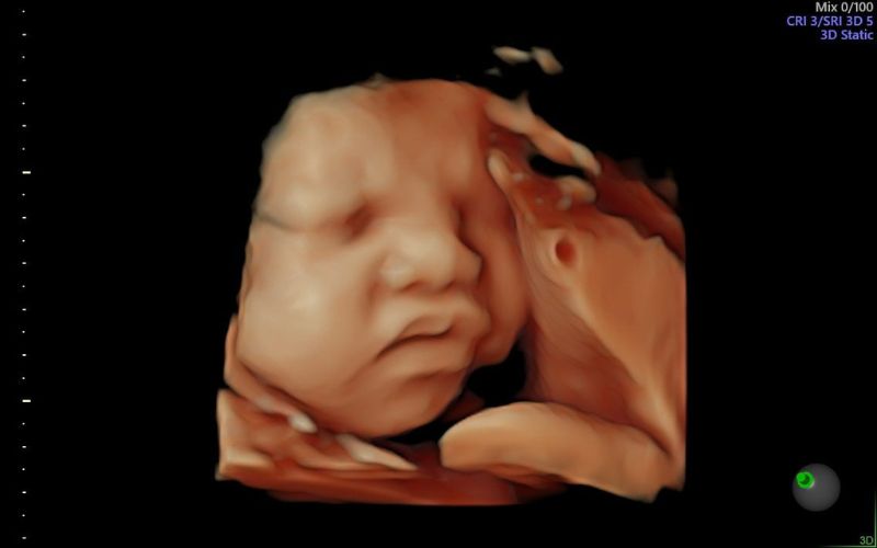 Siêu âm hình thái học có thể kiểm tra phần đầu của thai nhi