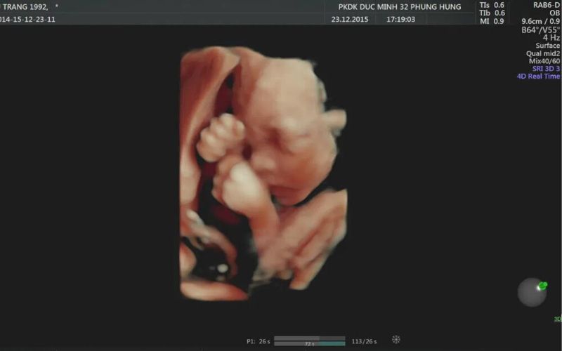 Siêu âm hình thái học có thể giúp quan sát tay, chân và các bộ phận khác của thai nhi
