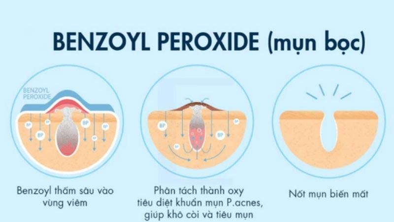 Benzoyl peroxide là một thành phần chăm sóc da dùng để điều trị mụn