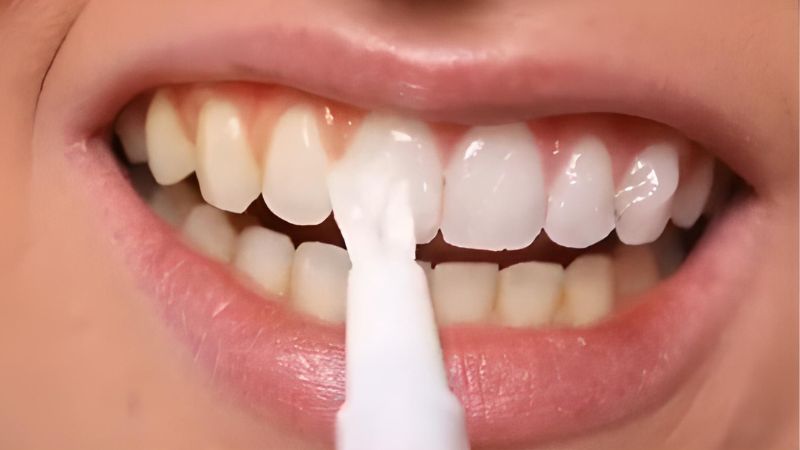 Bút tẩy trắng răng là gì?