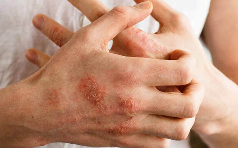 Viêm da và nhiễm trùng