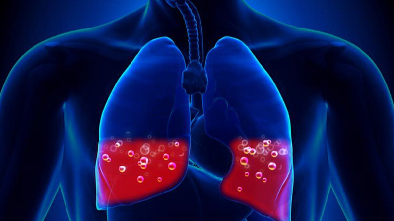 Ngộ độc Ethylene Oxide gây phù phổi, viêm phế quản