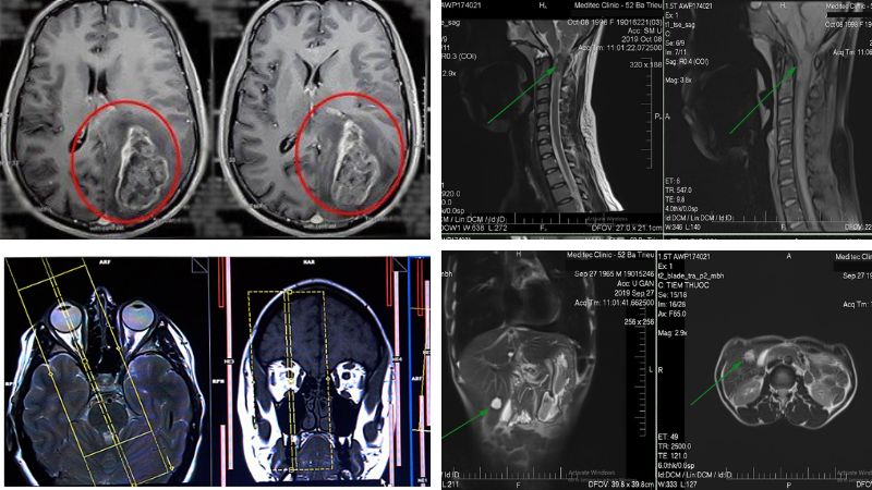 Bộ phận được chỉ định chụp cộng hưởng từ MRI