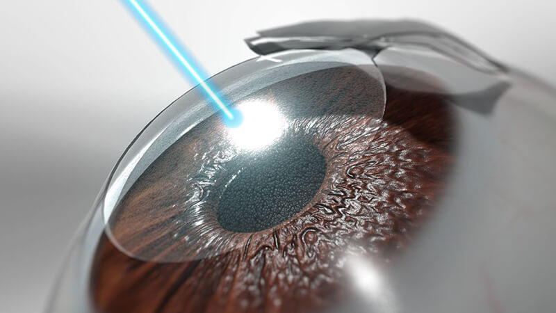 Loạn thị là một trong những tật khúc xạ mắt thường gặp