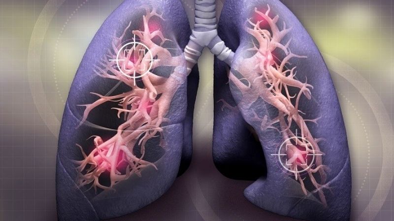 Nghệ đen giúp hỗ trợ điều trị các bệnh về phổi