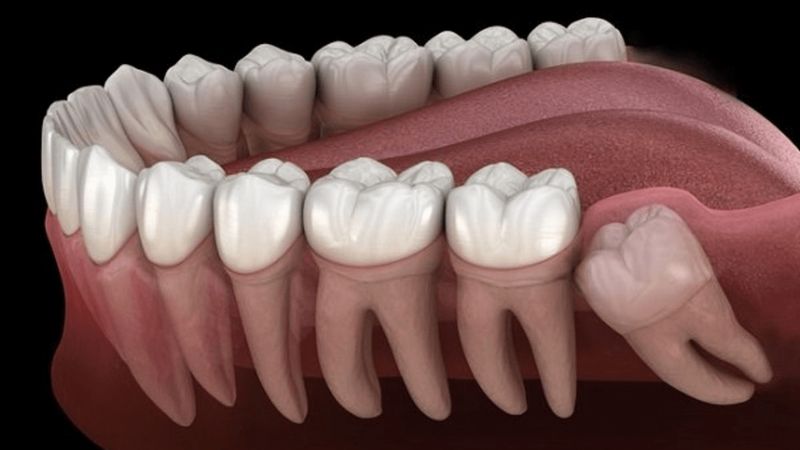 Răng khôn mọc ngầm là gì?