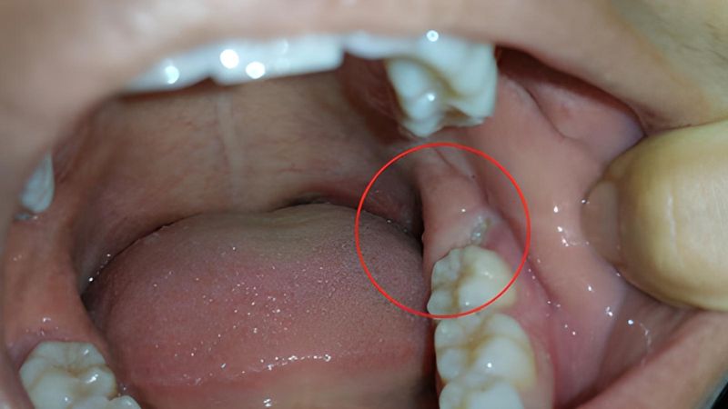 Răng khôn mọc ngầm có nguy hiểm không?