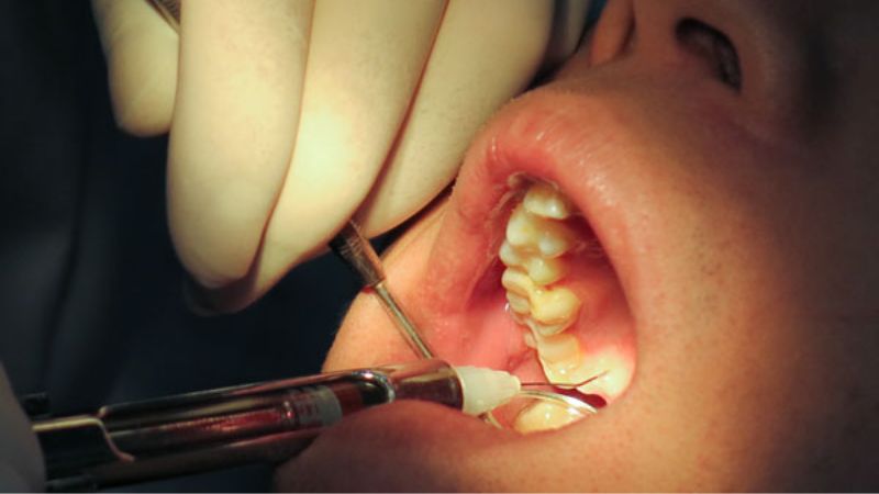 Một số trường hợp được chỉ định bắt buộc nhổ bỏ răng khôn