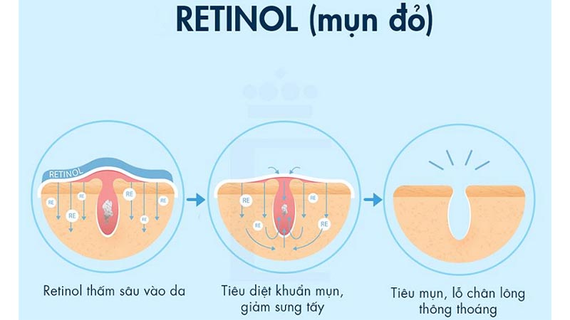 Retinol giúp điều trị mụn
