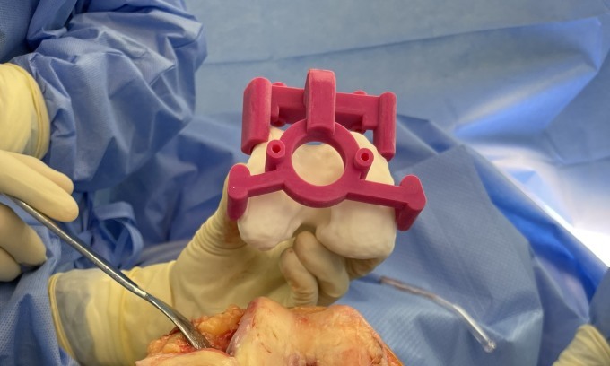 Thiết bị dẫn đường phẫu thuật cá thể hóa trong mổ thay khớp gối toàn phần. Ảnh: Trung tâm công nghệ 3D trong Y học, Đại học VinUni