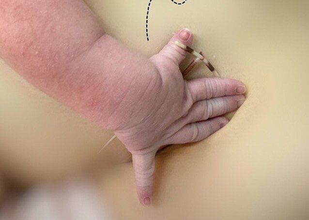 Ekip bác sĩ và điều dưỡng đã lấy vòng tránh thai đặt vào tay của bé đang da kề da với mẹ và chụp ảnh làm kỷ niệm. Ảnh: Bệnh viện cung cấp