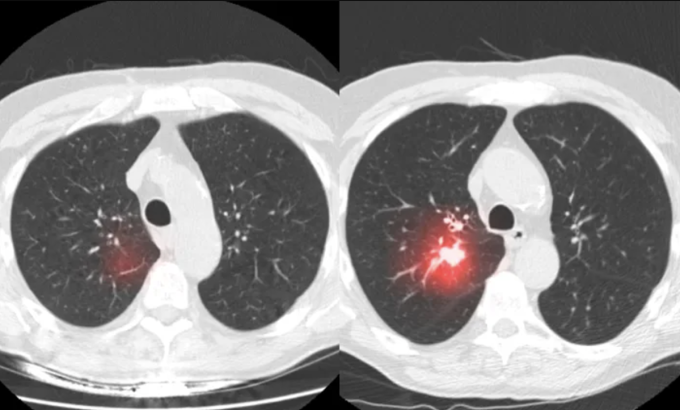AI phát hiện dấu hiệu bất thường trong phổi từ kết quả chụp CT. Ảnh: MIT and Mass General