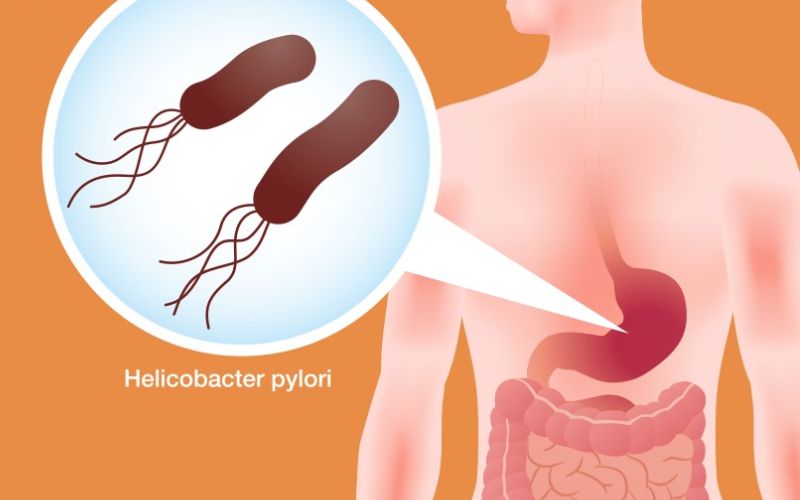 Nhiễm vi khuẩn Helicobacter pylori