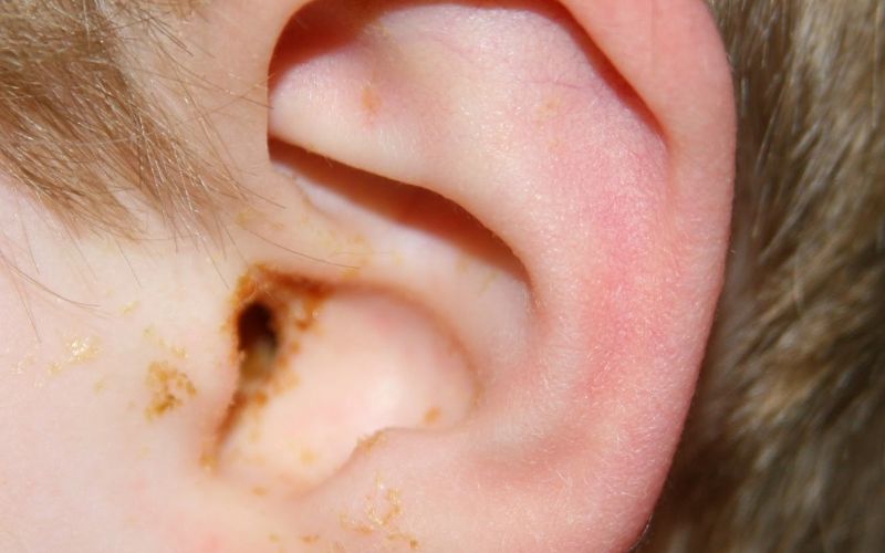 Viêm tai ngoài là gì, nguyên nhân gây bệnh?