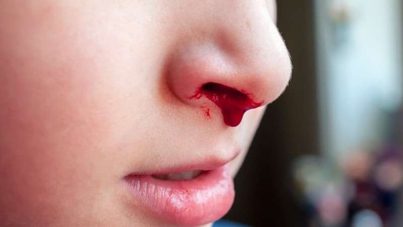 Những nguyên nhân gây chảy máu mũi ở trẻ là gì?