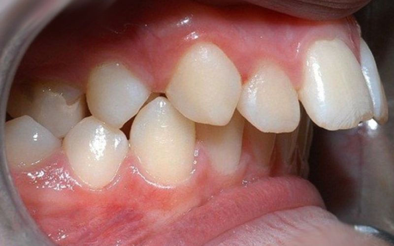 Đối tượng không thích hợp niềng răng trong suốt