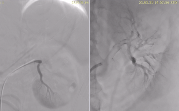 Hình ảnh thay đổi trước (trái) và sau khi can thiệp, các nhánh động mạch thận được tái thông. Ảnh: BVĐK Tâm Anh