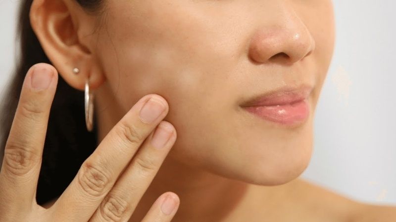 Skin Fasting không được khuyến khích cho làn da mụn