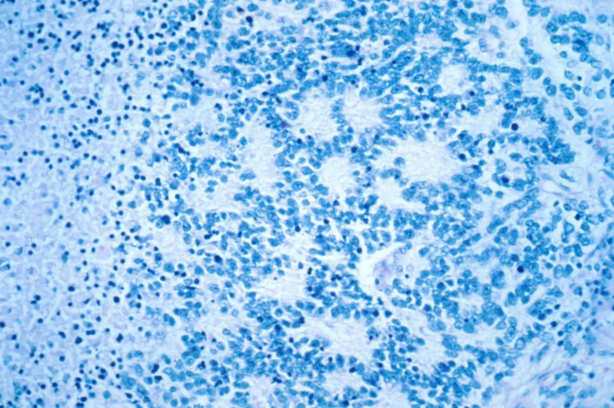 Ảnh chụp khối u nguyên bào thần kinh điển hình dưới kính hiển vi. Ảnh: National Cancer Institute