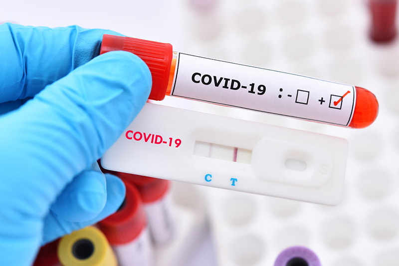 Xét nghiệm kháng thể COVID-19 là phương pháp xét nghiệm máu để tìm ra những virus SARS-CoV-2