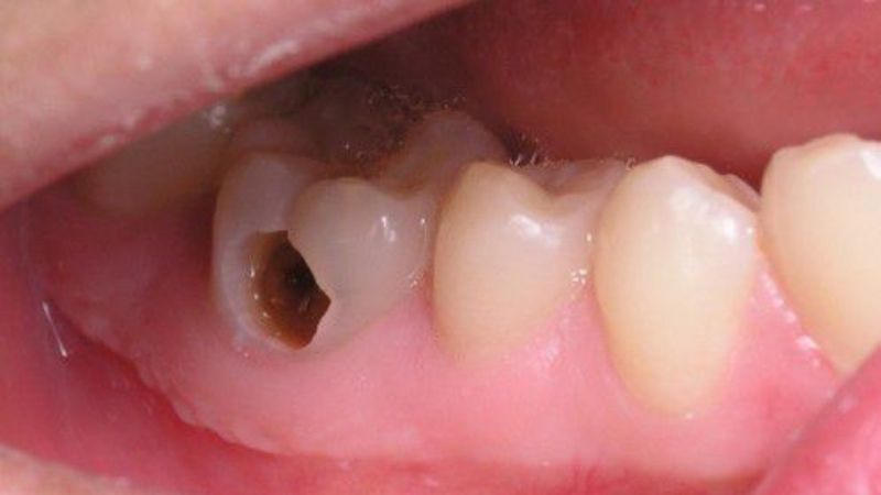 Một số nguyên nhân gây sâu răng
