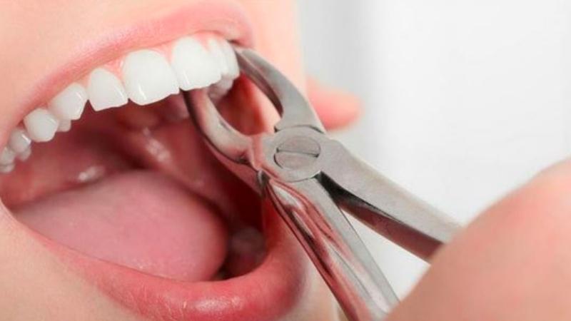 Răng sâu có nên nhổ không?