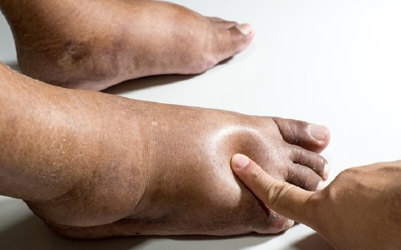 Chân bị sưng phù vì sao? Một số cách giảm phù nề chân tại nhà