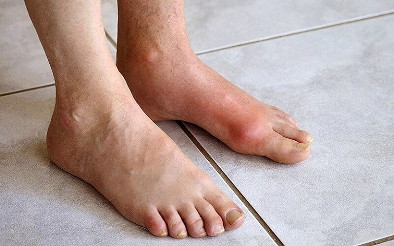 Bệnh gout xảy ra khi axit uric trong máu tích tụ, từ đó gây ra sưng phù