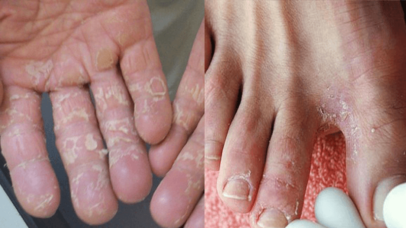 Nước ăn chân là hiện tượng chân xuất hiện vảy nấm, đặc biệt là ở kẽ chân hoặc những khu vực da bị ẩm, không được giữ khô thoáng.