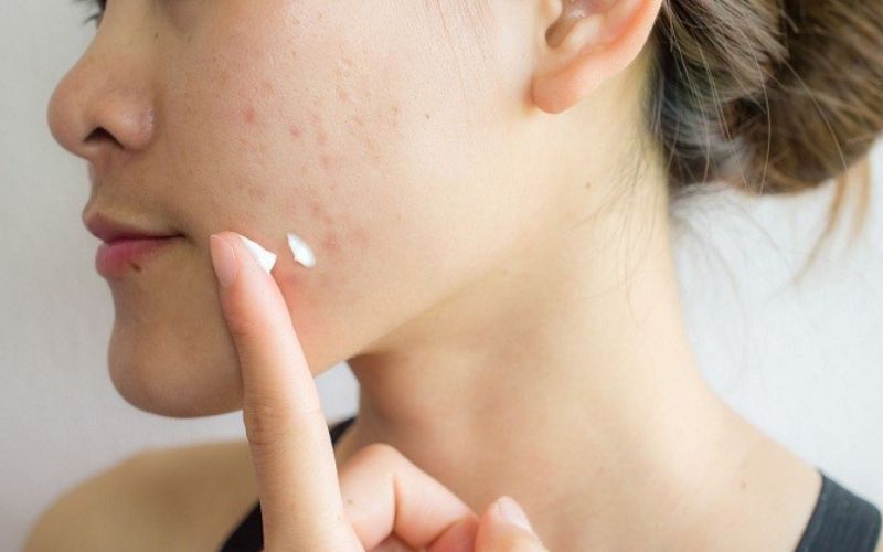 Cách chăm sóc da mặt sau khi nặn mụn